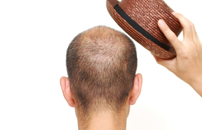 لبس القبعة بعد زراعة الشعر