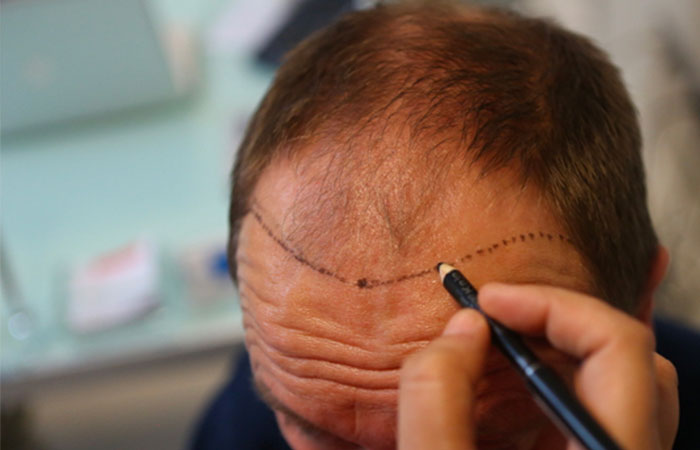 مين جرب زراعة الشعر في مصر
