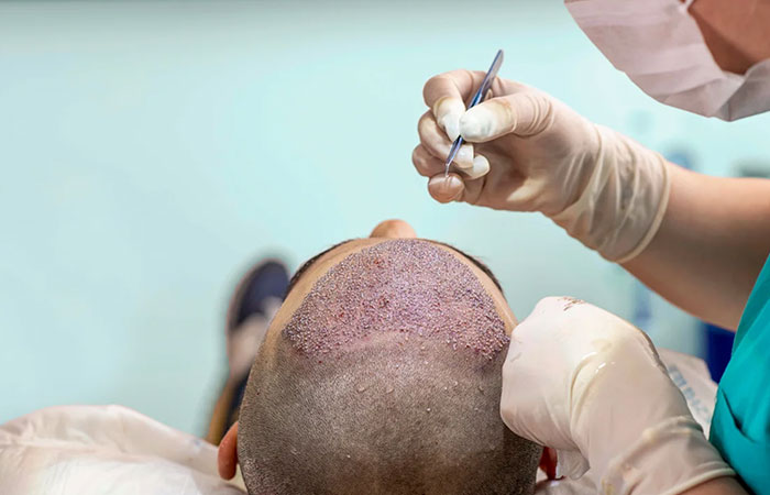 هل زراعة الشعر مكلفة