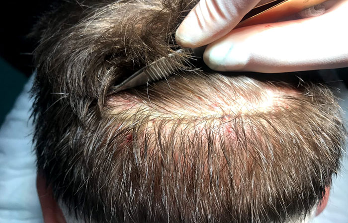 هل ينمو الشعر في المنطقة المانحة بعد عملية زراعة الشعر