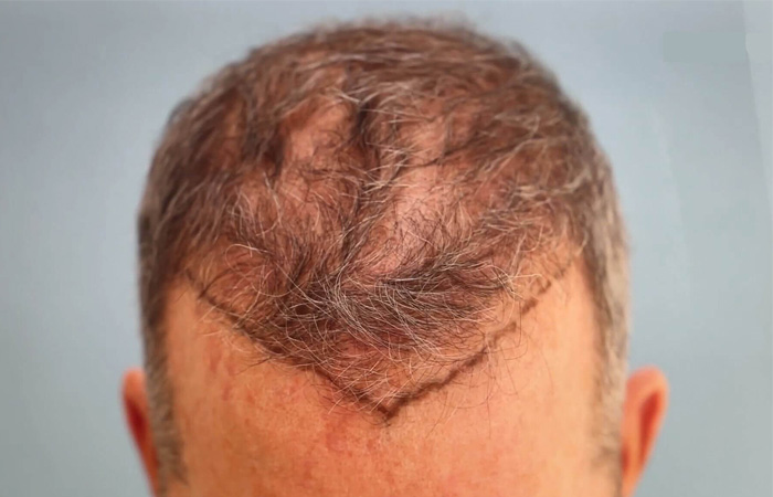 أسباب فشل زراعة الشعر
