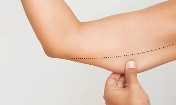 شفط دهون الذراعين بالفيزر