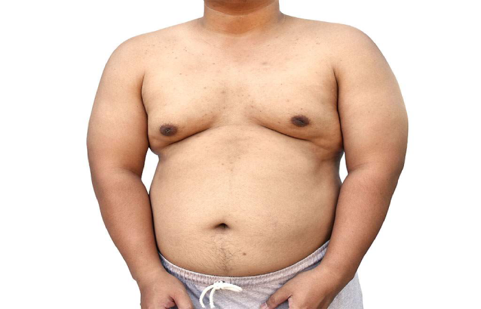 علاج تضخم الثدي عند الرجال