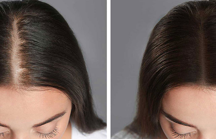 هل زراعة الشعر ناجحة للنساء
