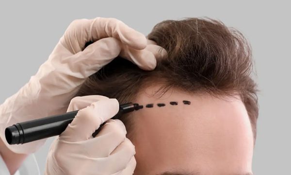 أحدث طرق زراعة الشعر بدون جراحة