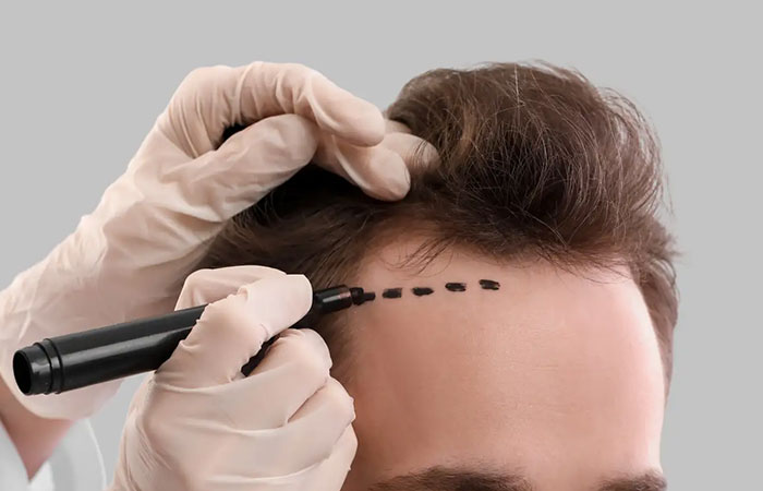 أحدث طرق زراعة الشعر بدون جراحة