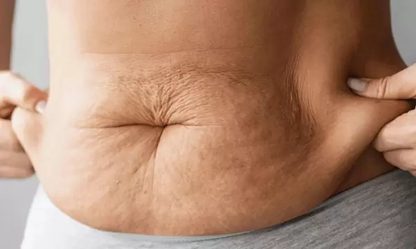 ترهلات بعد الولادة