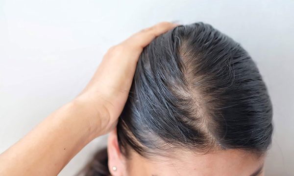 زرع شعر للنساء