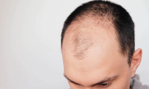 سعر عمليات زرع الشعر