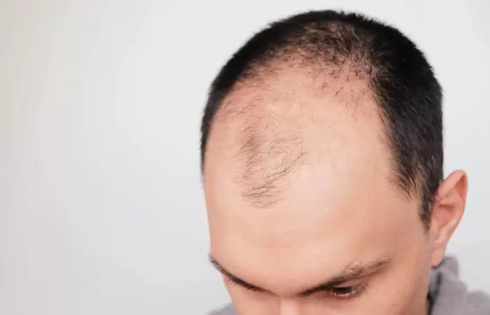 سعر عمليات زرع الشعر