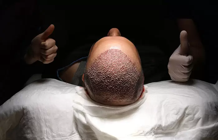 نصائح بعد زراعة الشعر