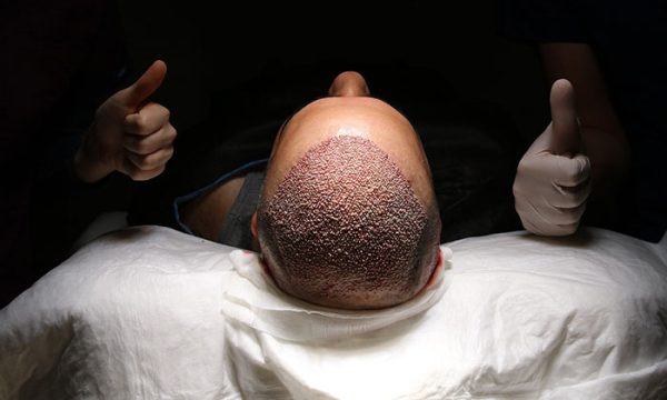 نصائح بعد زراعة الشعر