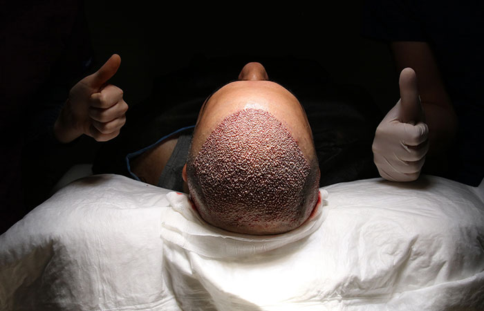 نصائح بعد زراعة الشعر