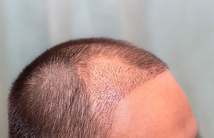 أفضل دكتور زراعة شعر