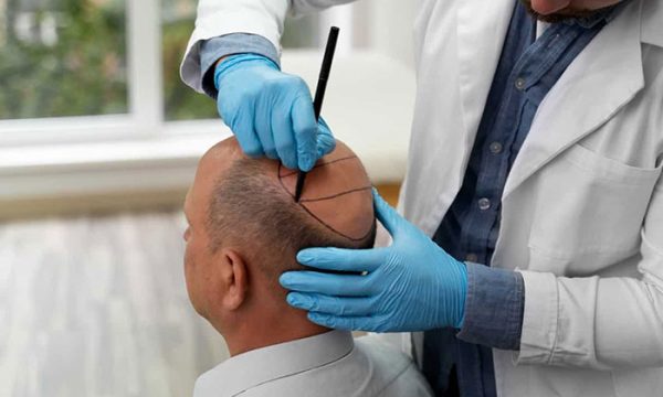 افضل دكتور في زراعة الشعر