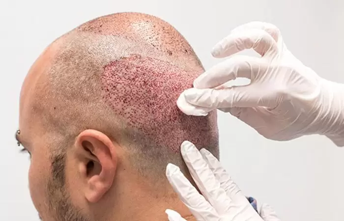 الاعراض الجانبية لزراعة الشعر