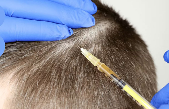 البلازما بعد زراعة الشعر