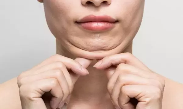 انتفاخ الوجه بعد شفط الذقن