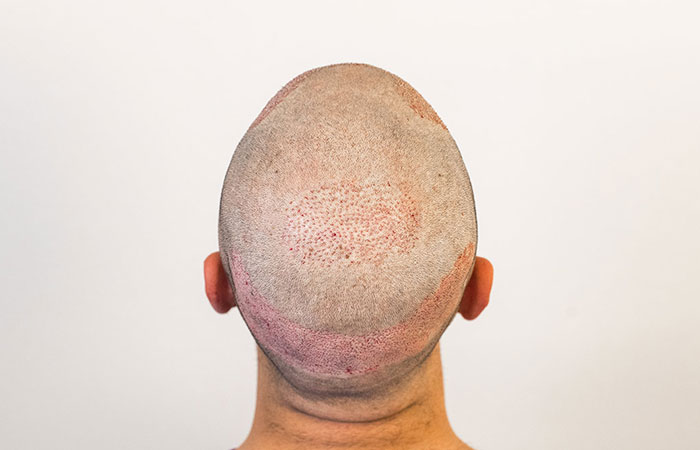تساقط الشعر بعد زراعة الشعر
