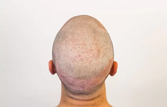 تساقط الشعر بعد زراعة الشعر