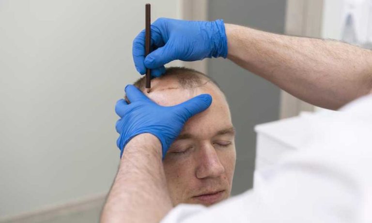 تورم الوجه بعد عملية زراعة الشعر