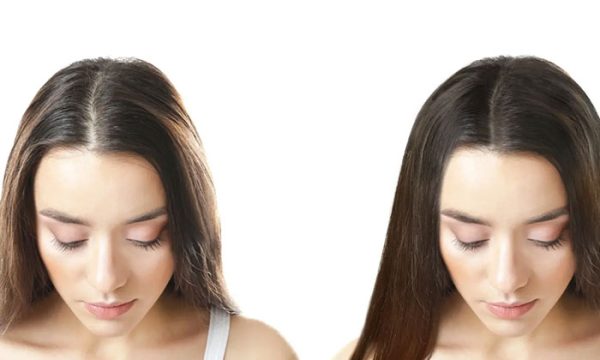 زراعة الشعر للبنات