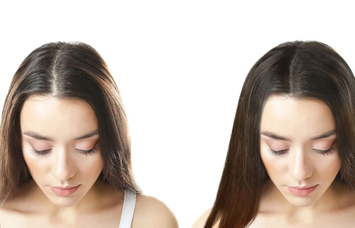 زراعة الشعر للبنات