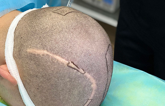 زراعة الشعر مكان الجروح