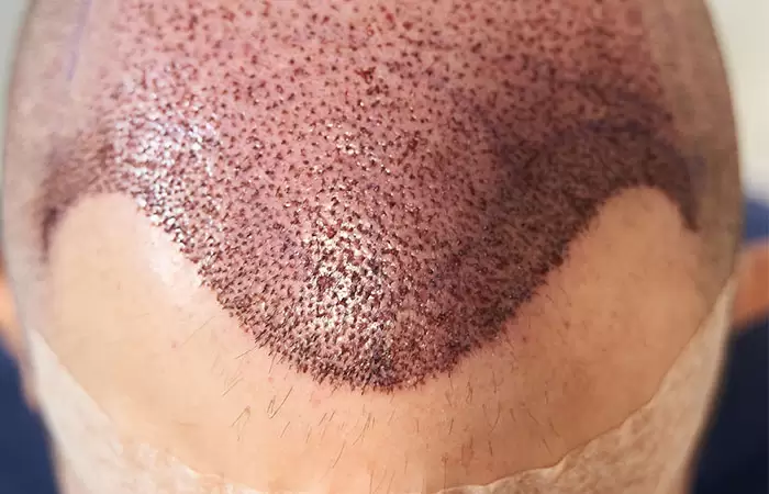 شكل الرأس بعد زراعة الشعر