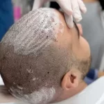 غسيل الشعر بعد الزراعة