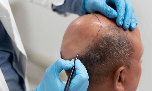 فوائد زراعة الشعر