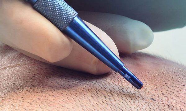 قلم السفير لزراعة الشعر