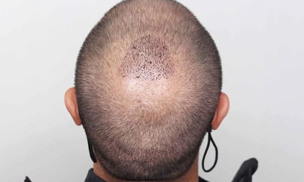 كيفية زراعة الشعر للرجال