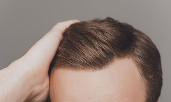 مدة عملية زراعة الشعر