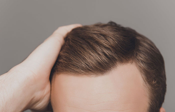 مدة عملية زراعة الشعر