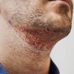 مشاكل زراعة الذقن