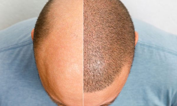 أفضل مركز زراعة شعر