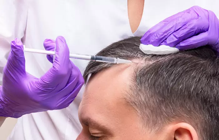 ابر البلازما بعد زراعة الشعر