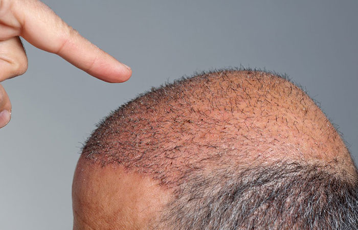 افضل دولة لزراعة الشعر