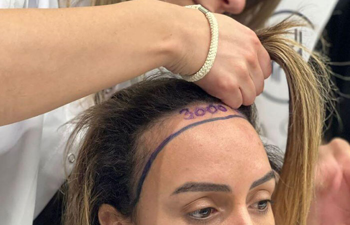 تجارب زراعة شعر الجبهة للنساء