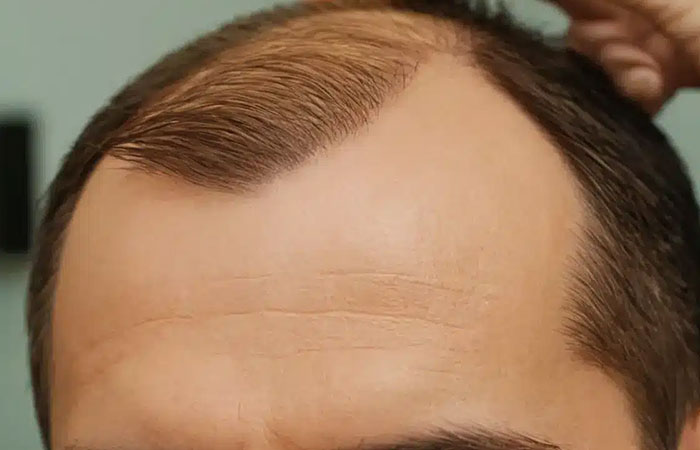تكلفة زراعة الشعر في تركيا