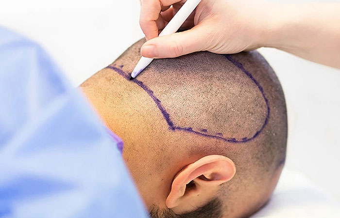 زراعة الشعر في الدمام