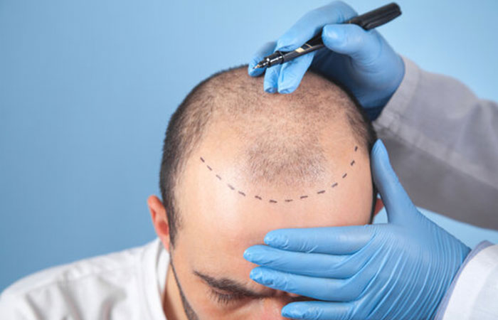 زراعة الشعر في السعودية
