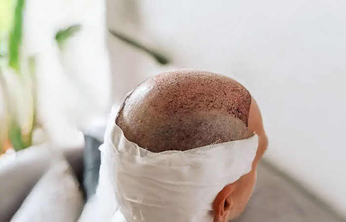 زراعة الشعر في الصيف