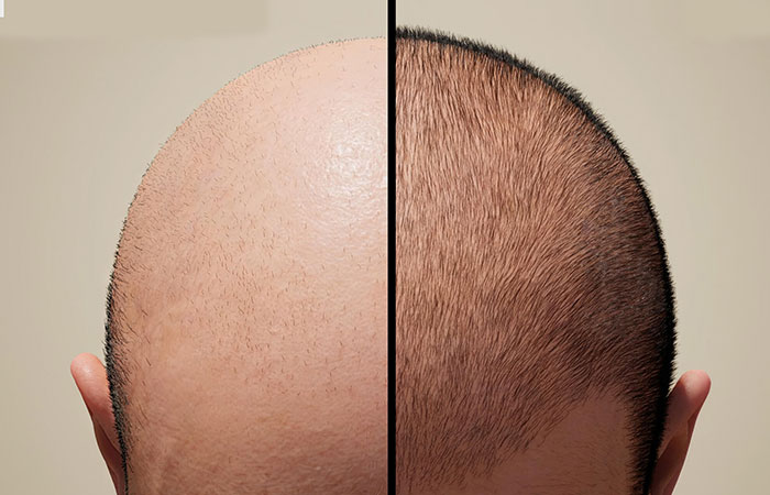 زراعة الشعر في الكويت