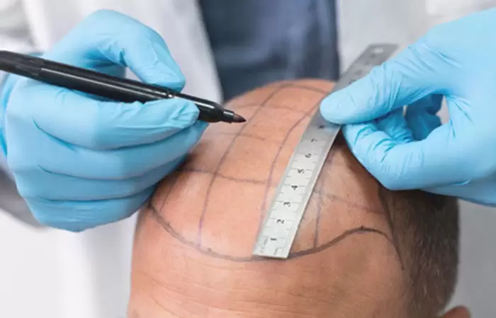 زراعة الشعر في جدة