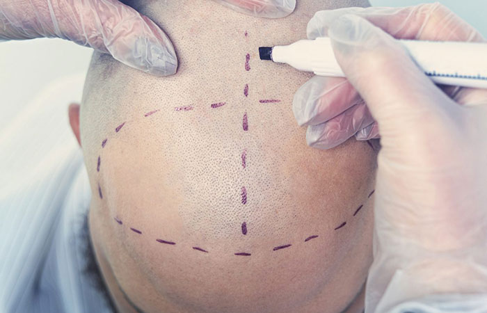 زراعة الشعر في قطر