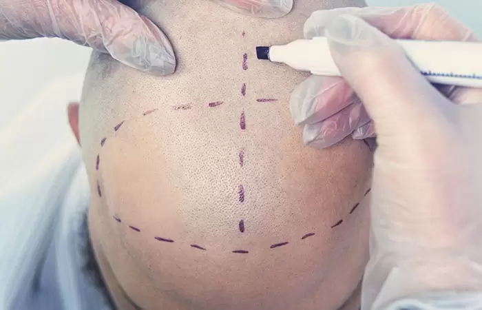 زراعة الشعر في قطر