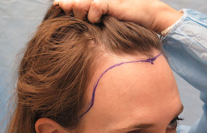 زراعة الشعر في مقدمة الرأس للنساء