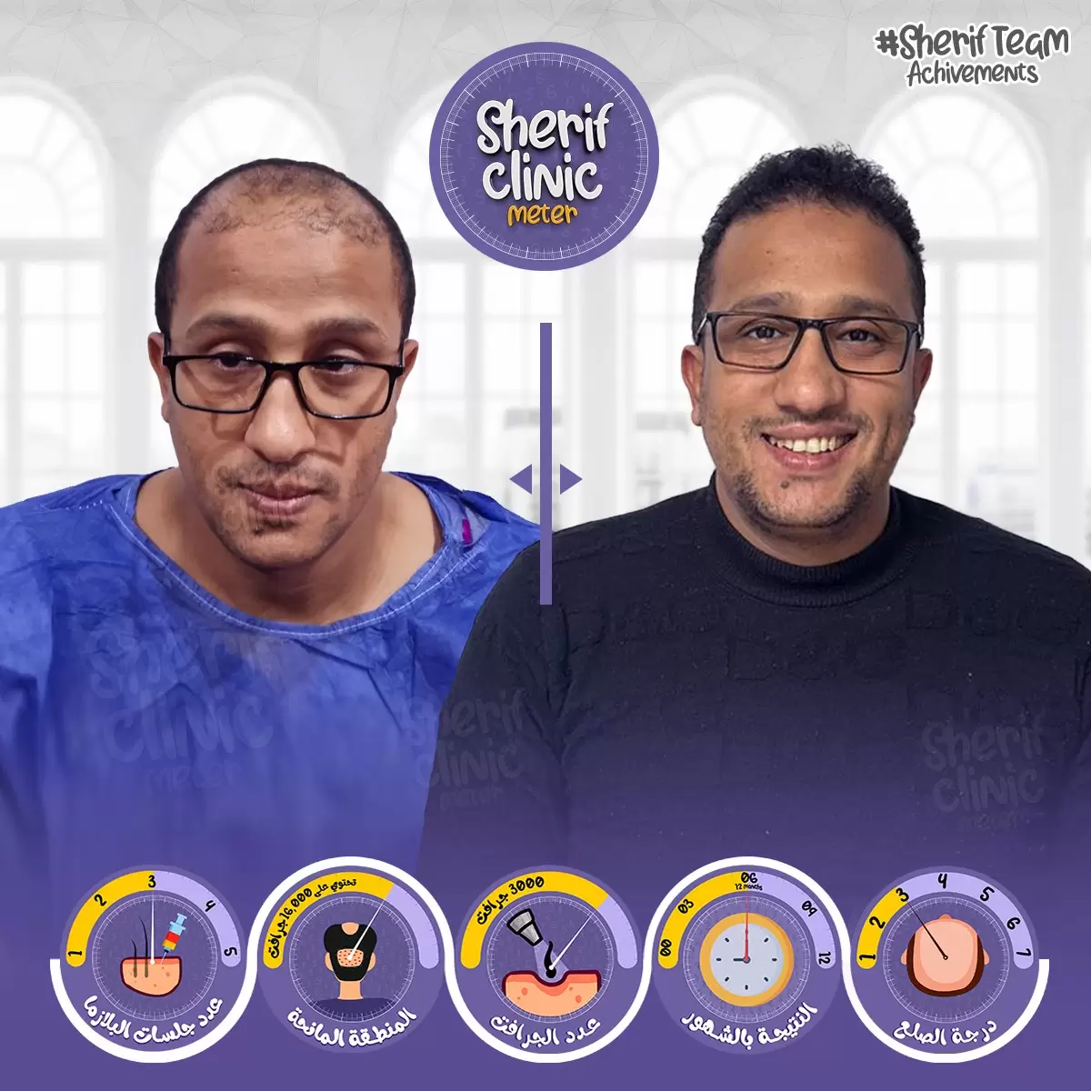 نقششة وزراعة الشعر 2
